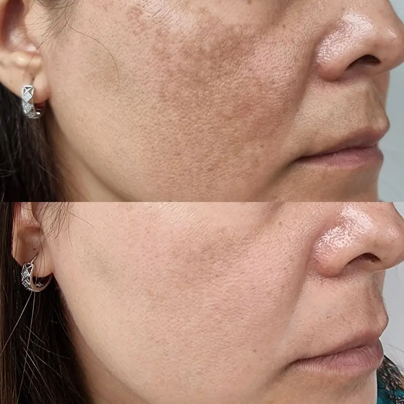 avant après peeling localisé