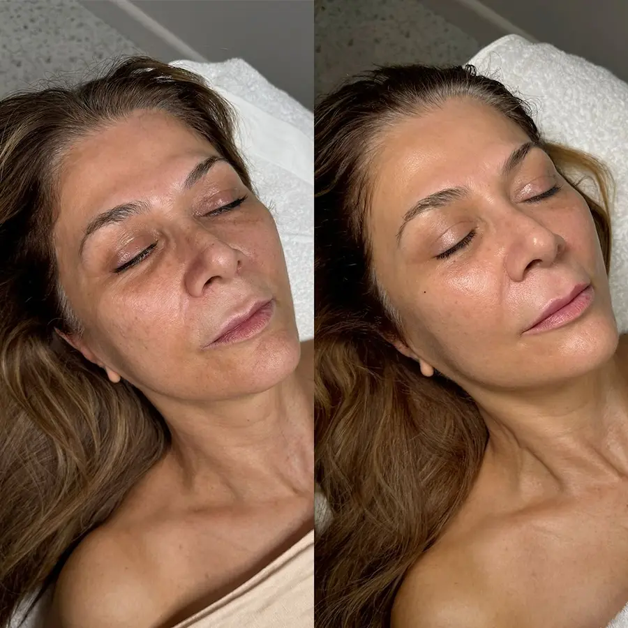 avant apres skin booster