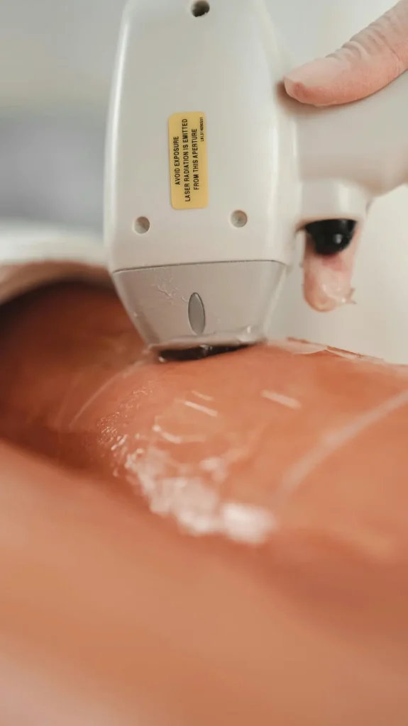 epilation laser a paris et marrakech