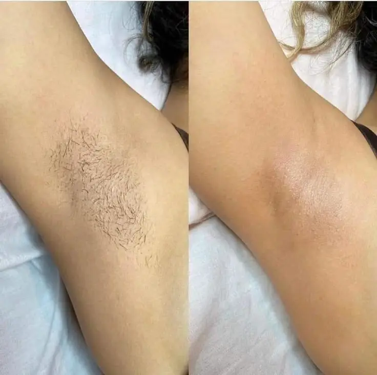 epilation laser avant apres